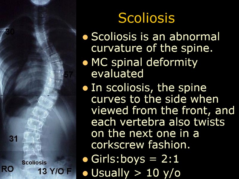Scoliosis Scoliosis is an abnormal curvature of the spine. MC spinal deformity evaluated In